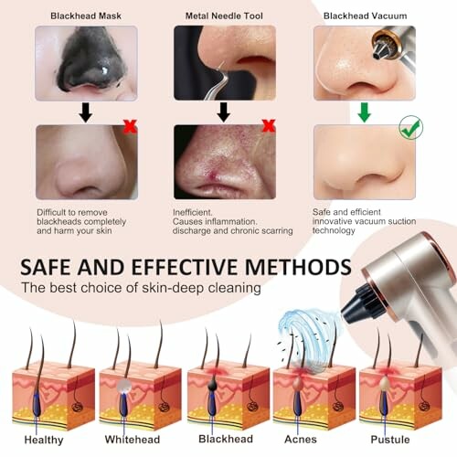 Comparison of blackhead removal methods: mask, needle tool, and vacuum.
