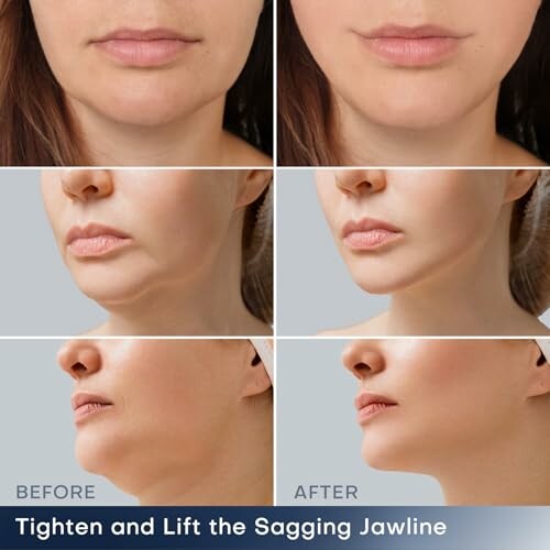 Before and after images showing jawline tightening and lifting results.