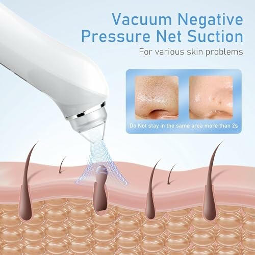 Illustration of a vacuum negative pressure net suction device for skin care.